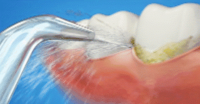 「口腔视界」如何使用水牙线，这些小技巧送给你